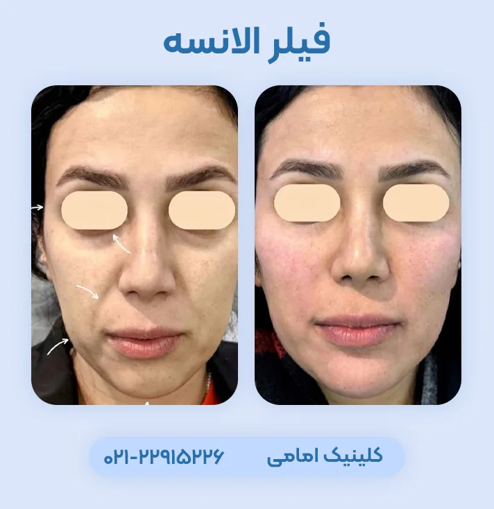 قبل و بعد فیلر الانسه