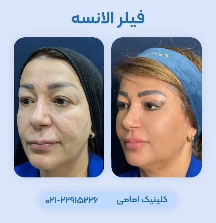 فیلر الانسه