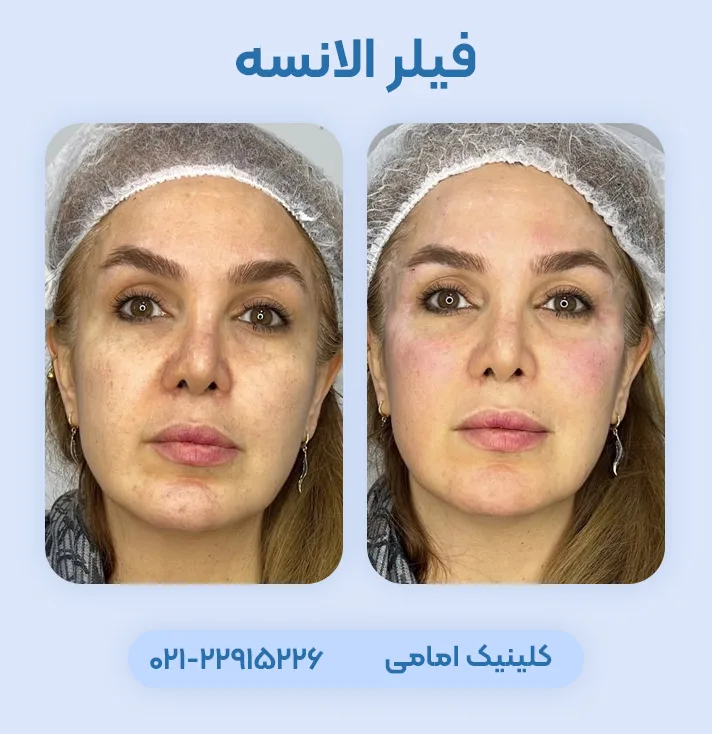 فیلر الانسه قبل بعد