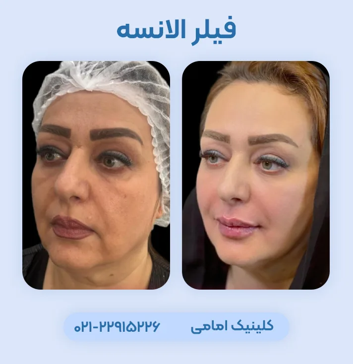 فیلر الانسه قبل بعد