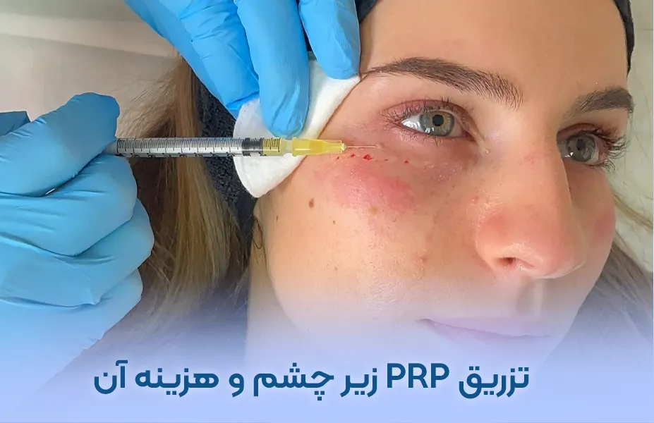 هزینه جدید prp زیر چشم در تهران +عکس