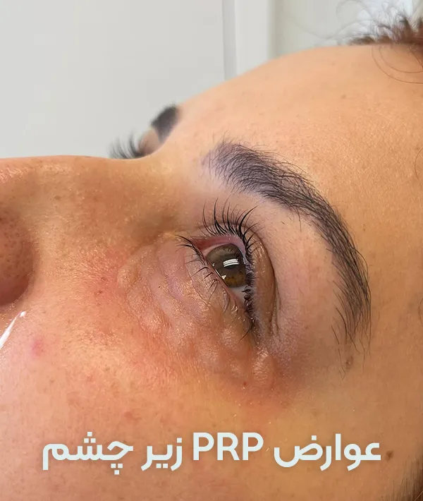 عوارض prp زیر چشم