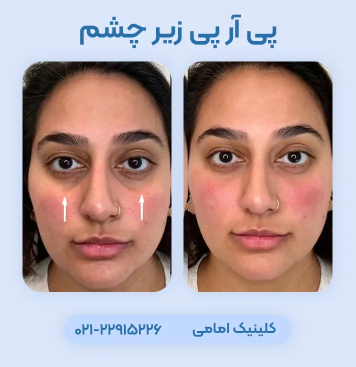 prp زیر چشم