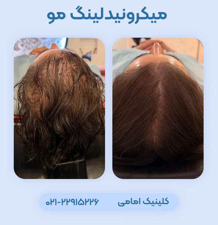 قبل و بعد میکرونیدلینگ مو سر