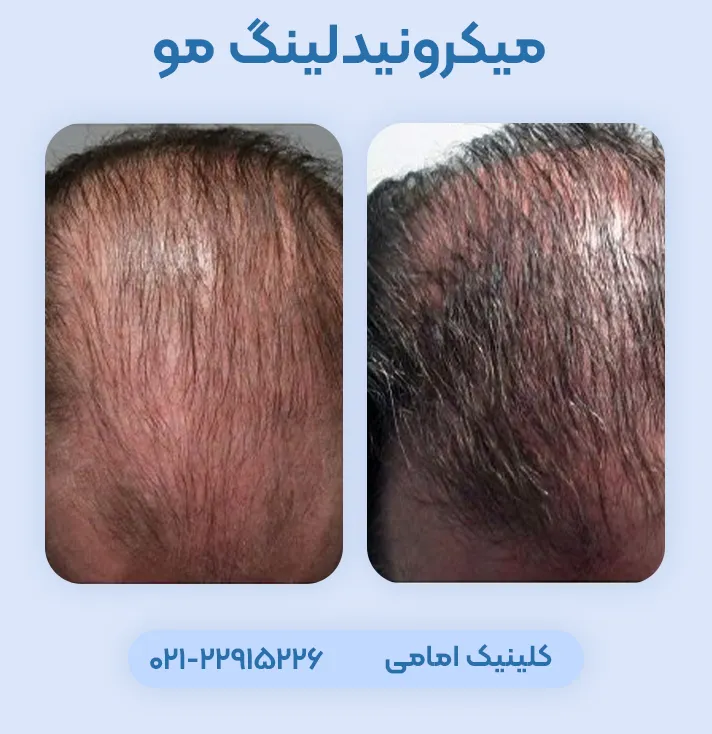 قبل و بعد میکرونیدلینگ مو سر