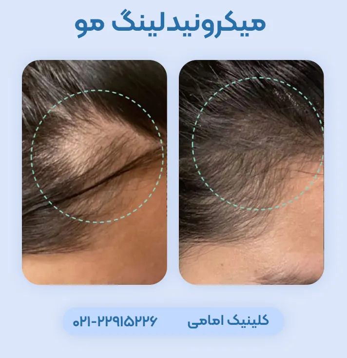 قبل و بعد میکرونیدلینگ مو سر