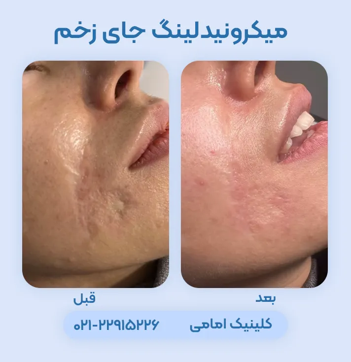 میکرونیدلینگ برای جای زخم