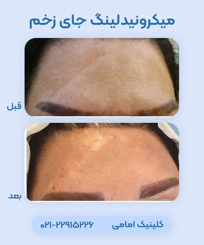 میکرونیدلینگ جای بخیه