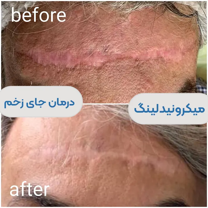 میکرونیدلینگ برای جای زخم