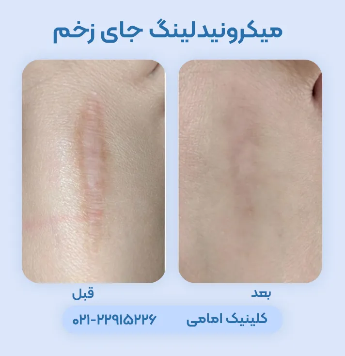میکرونیدلینگ جای بخیه