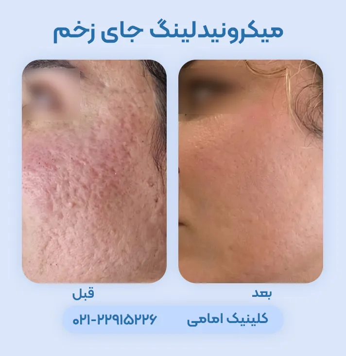 میکرونیدلینگ برای جای زخم