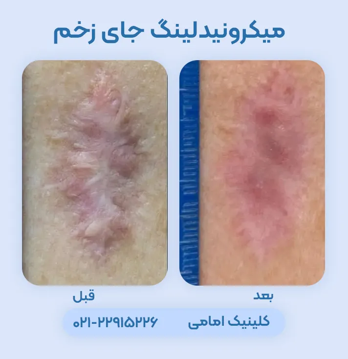 میکرونیدلینگ برای جای زخم