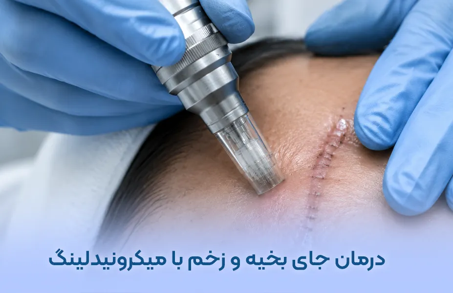 درمان جای بخیه و زخم با میکرونیدلینگ + لیست هزینه تهران