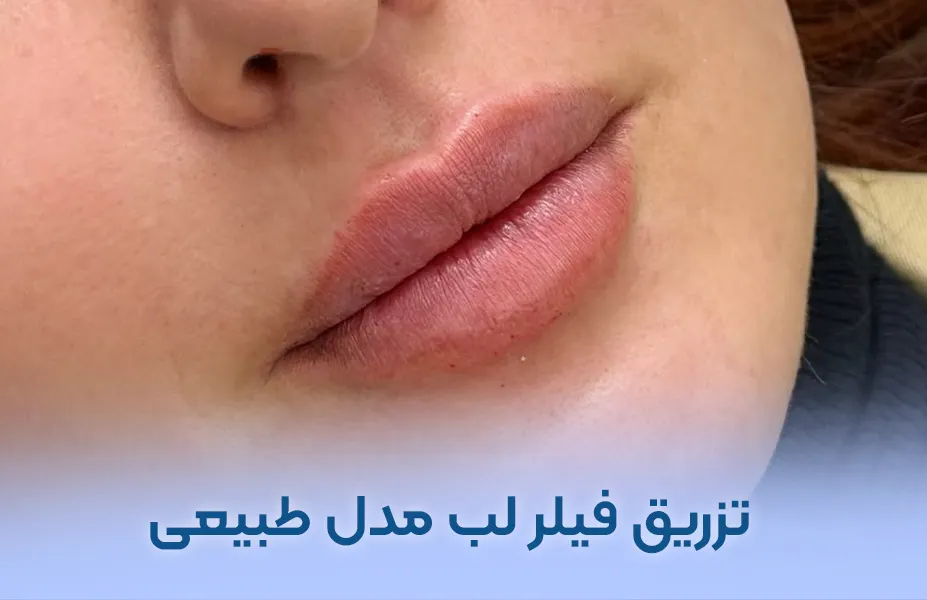 تزریق فیلر لب مدل طبیعی و نچرال + عکس قبل بعد