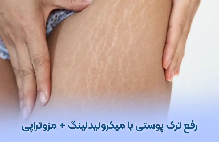رفع ترک پوستی استرچ مارک با میکرونیدلینگ + مزوتراپی