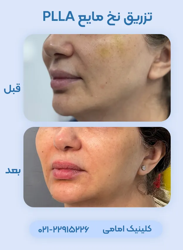 نخ مایع PLLA
