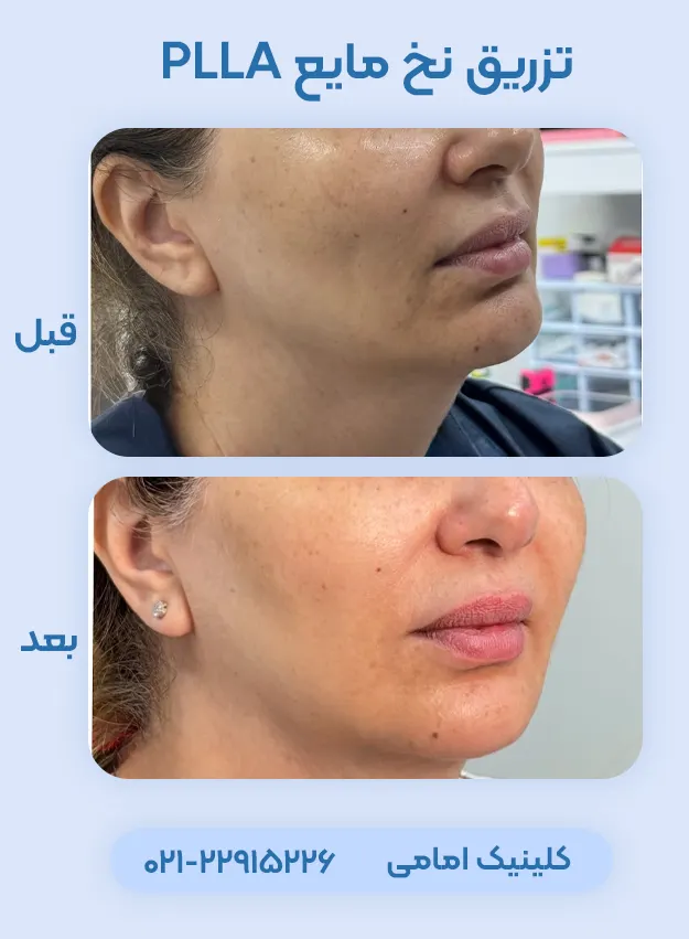نخ مایع PLLA