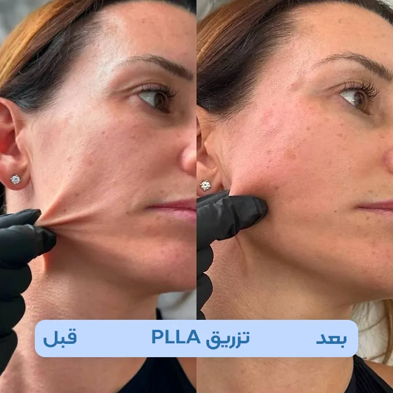 نخ مایع PLLA