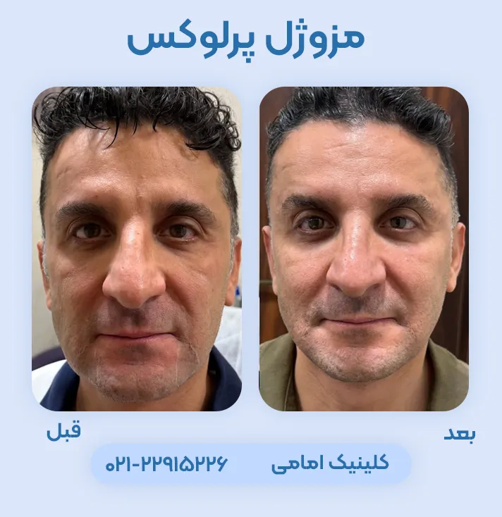 قبل و بعد مزوژل جوانساز پرلوکس