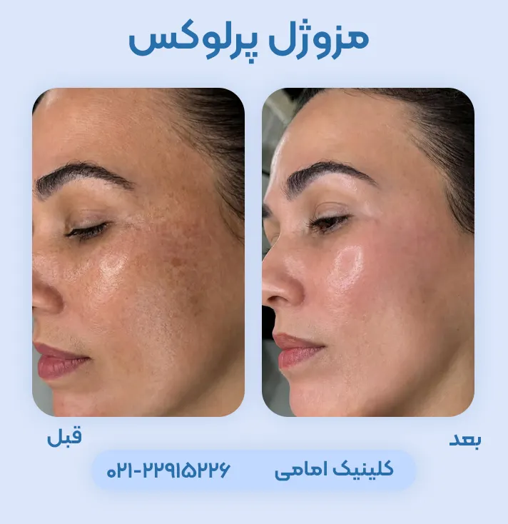 قبل و بعد مزوژل جوانساز پرلوکس