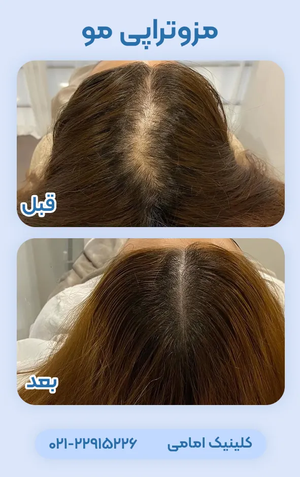 قبل و بعد مزوتراپی مو