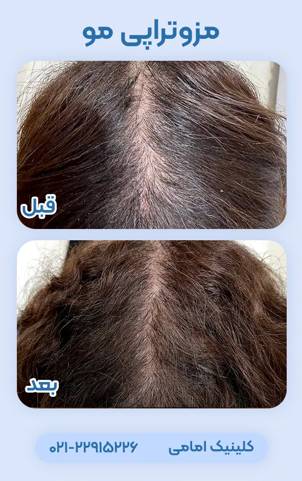 قبل و بعد مزوتراپی مو