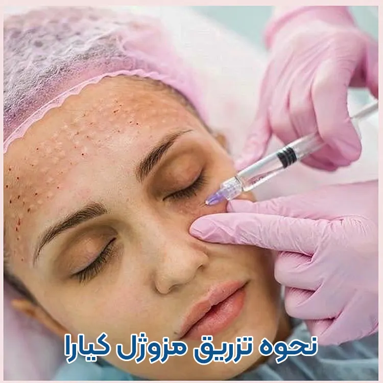 نحوه تزریق مزوژل کیارا