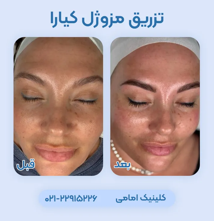 قبل و بعد تزریق مزوژل کیارا