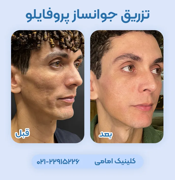 عکس قبل و بعد تزریق پروفایلو