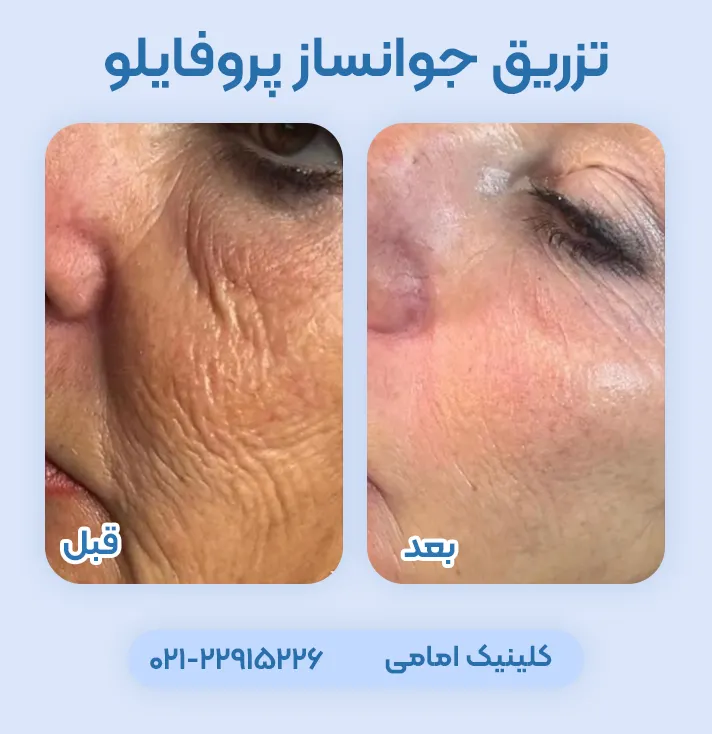 عکس قبل و بعد تزریق پروفایلو استراکچرا