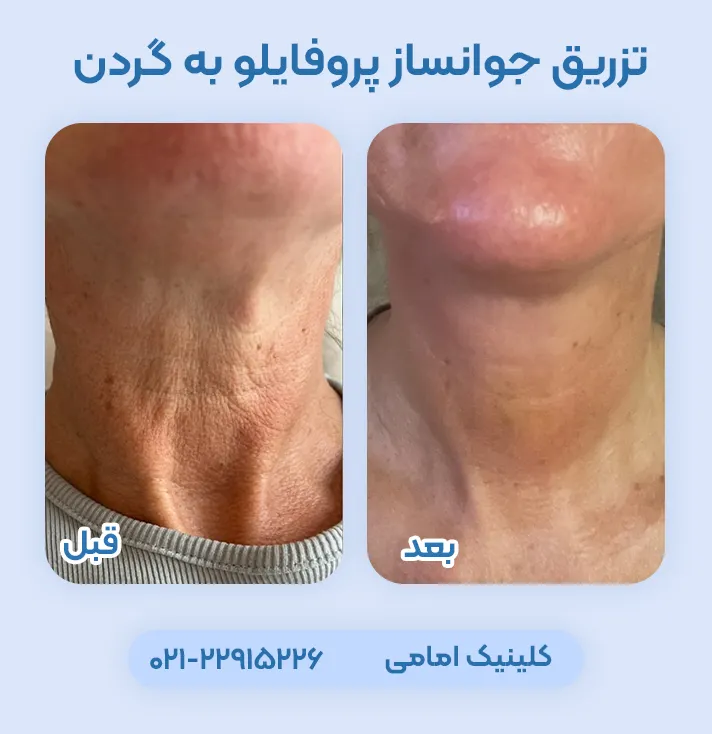 عکس قبل و بعد تزریق پروفایلو گردن