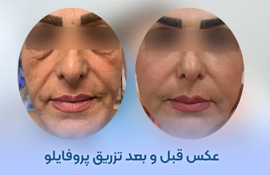 عکس قبل و بعد تزریق پروفایلو
