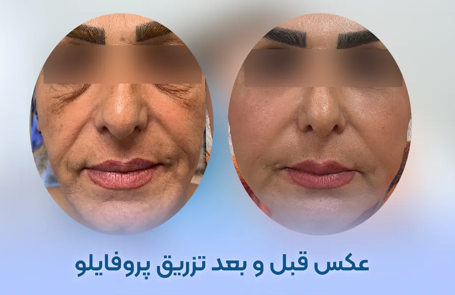 عکس قبل و بعد تزریق پروفایلو + قیمت پروفایلو