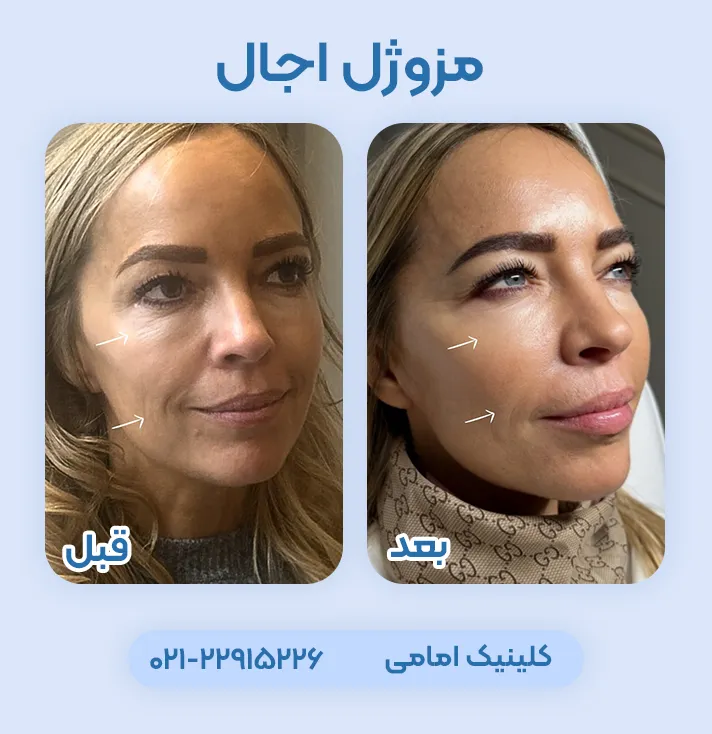 قبل و بعد مزوژل اجال ۴۰