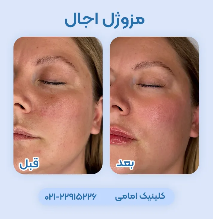 مزوژل اجال ۴۰ قبل و بعد