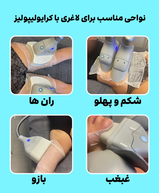 کرایولیپولیز برای چه افرادی مناسب است؟