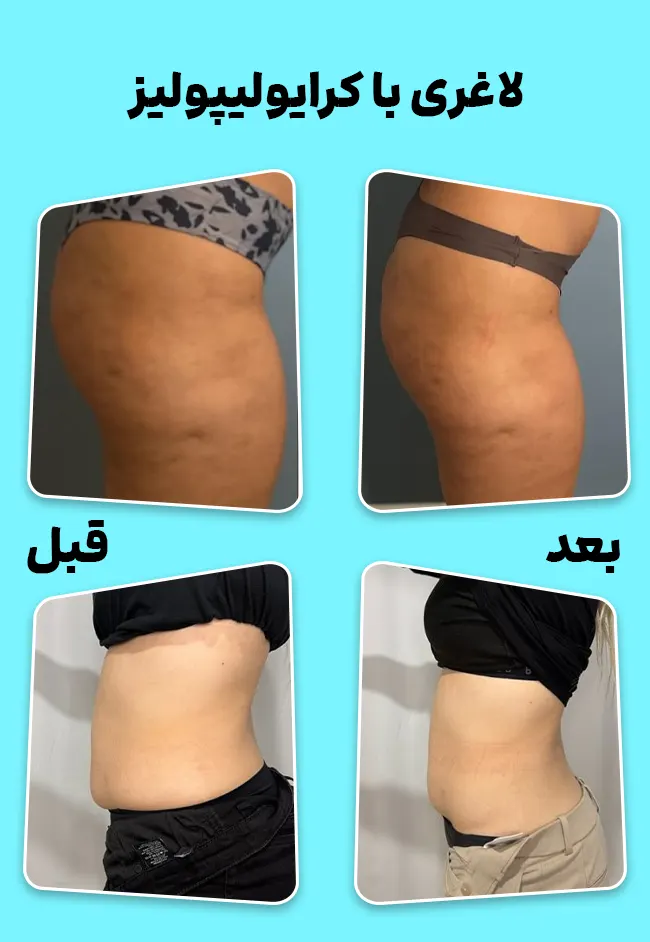 کرایولیپولیز برای چه افرادی مناسب است؟