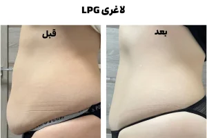 لاغری با دستگاه LPG