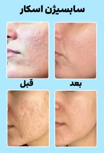 قبل و بعد سابسیژن