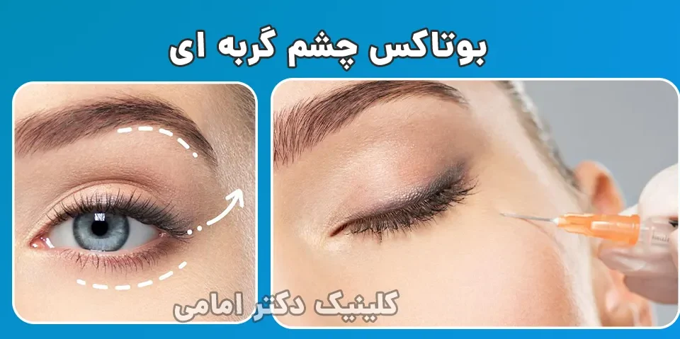 تزریق بوتاکس چشم گربه ای