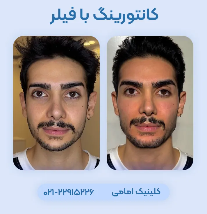 کانتورینگ صورت با فیلر