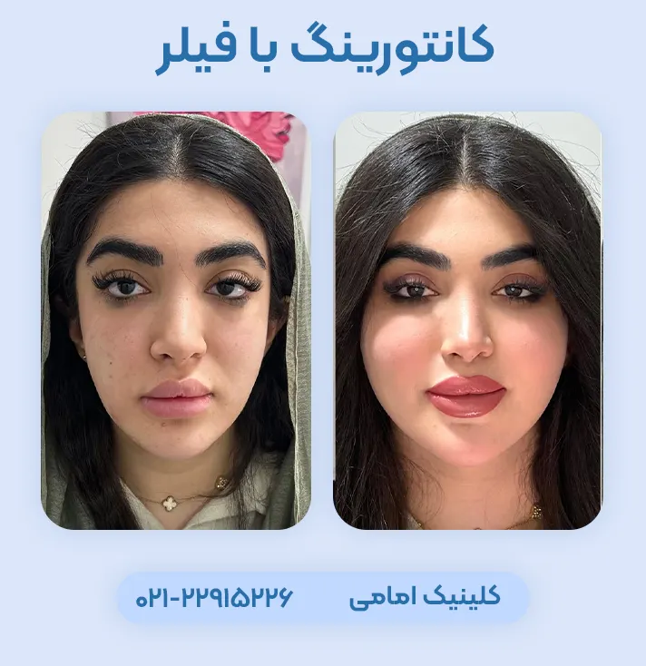 کانتورینگ صورت با فیلر
