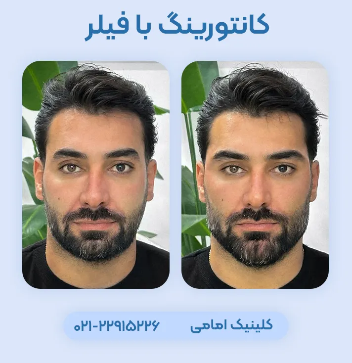 کانتورینگ صورت با فیلر