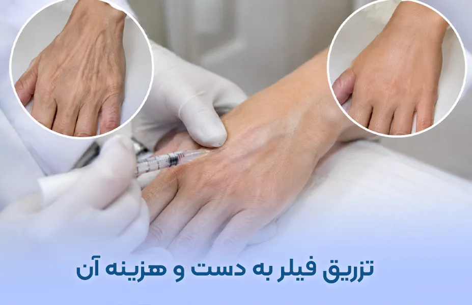 تزریق فیلر دست