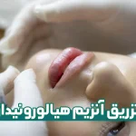 آنزیم هیالورونیداز