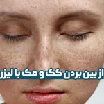 لیزر کک و مک