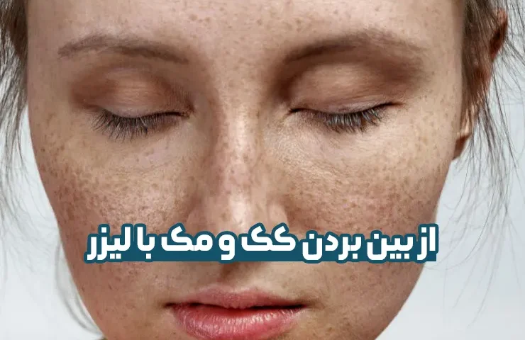 لیزر کک و مک