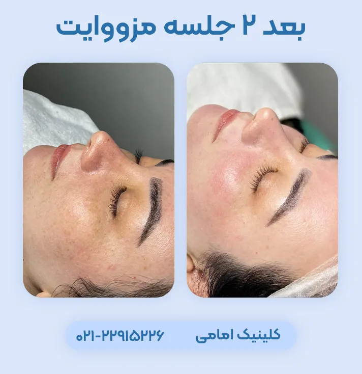 قبل بعد مزووایت