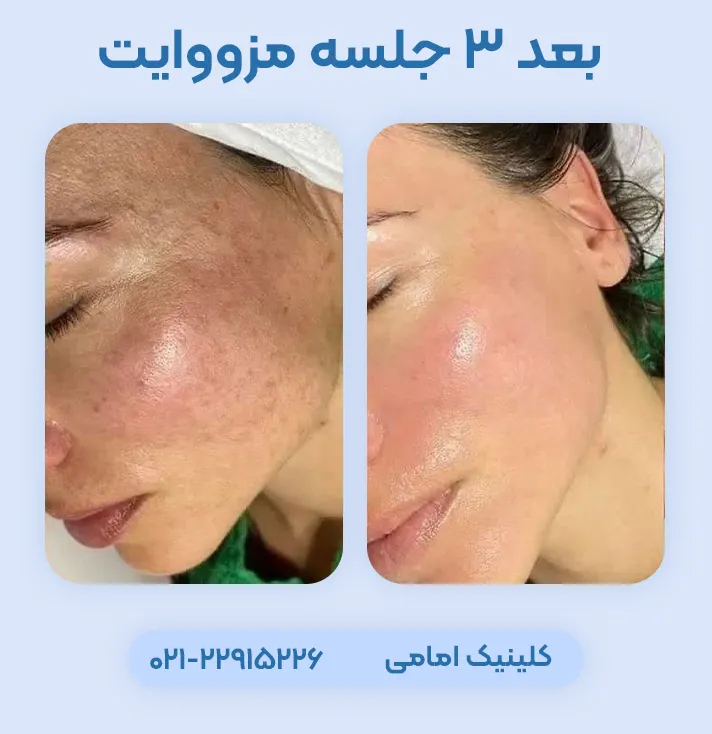 قبل بعد مزووایت