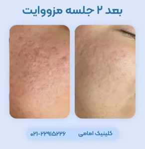 قبل بعد مزووایت